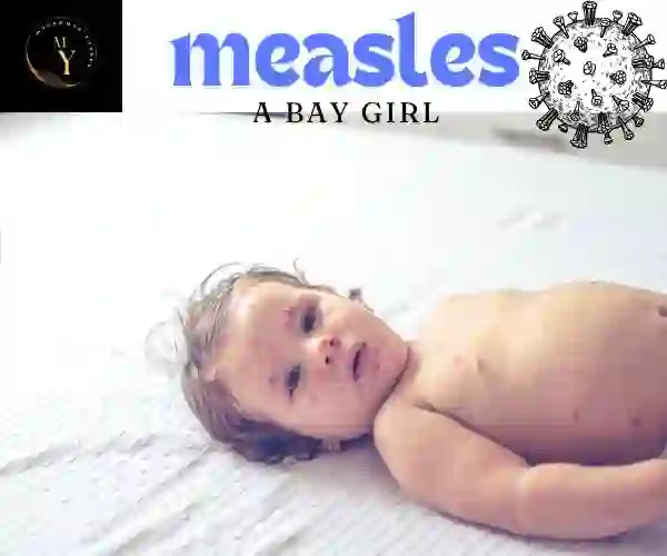 A BABY WITH MEASLES