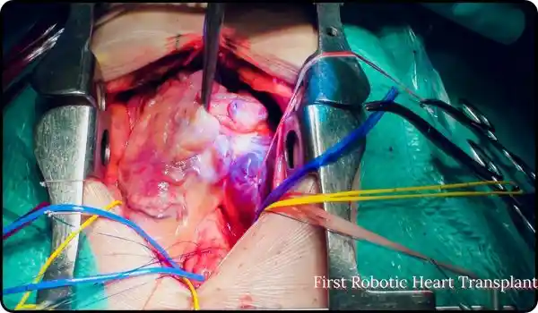 first robotic heart transplant in KSA