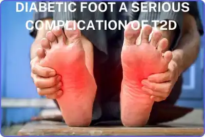 DIABETIC FOOT A SERIOUS COMPLICATION OF T2D